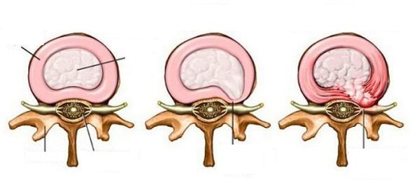 ไส้เลื่อน intervertebral กับปากมดลูก osteochondrosis