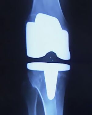 x -ray picture of the knee กับอวัยวะเทียมหลังจากการผ่าตัดเพื่อเปลี่ยนข้อต่อ
